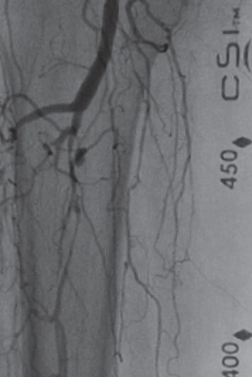 Right Anterior Tibial CTO Before Treatment. 100% stenosis.