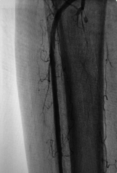 Right Anterior Tibial Post OAS and PTA. <5% stenosis.