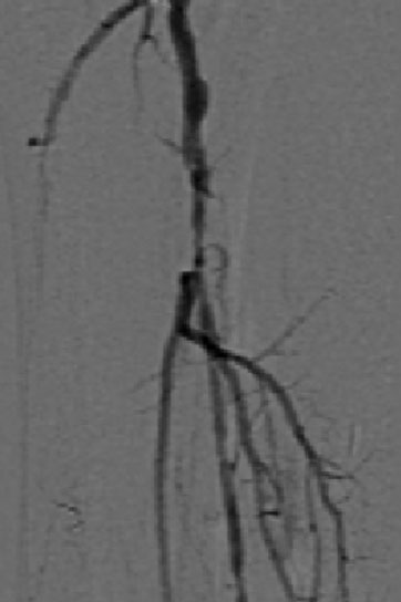 Anterior Tibial Target Lesion. 3mm x 220mm. ~95% stenosis.