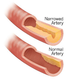 Narrowed Artery Illustration Coronary Artery Disease
